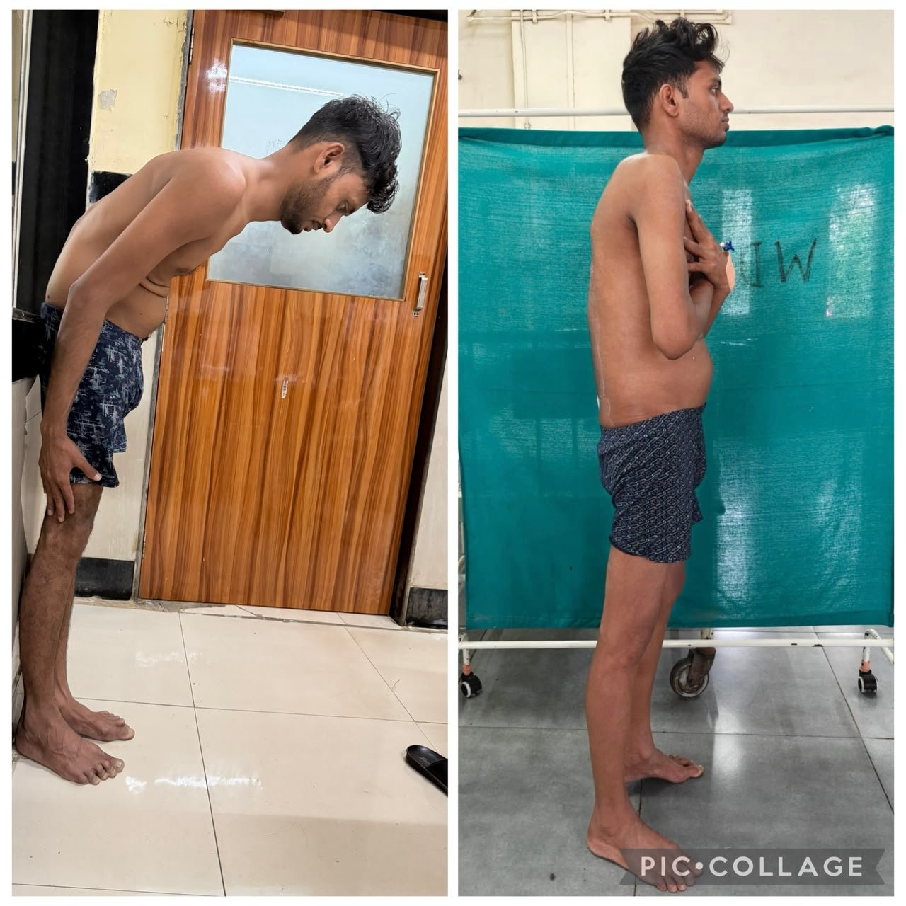 सहा वर्षे कमरेत वाकलेले आयुष्य एका शस्त्रक्रियेत झाले सरळ; ३२ वर्षीय तरुण पुन्हा ताठ उभा!